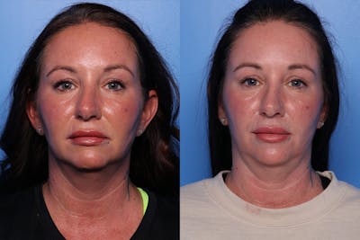 CO2 Laser Resurfacing Before & After Gallery - Patient 778645 - Image 1