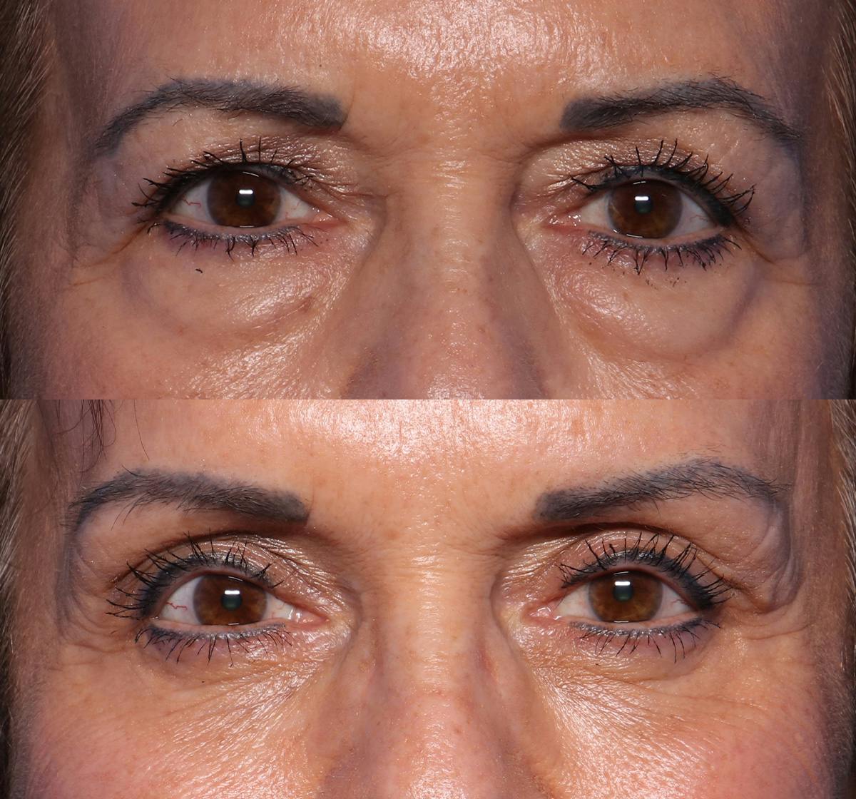Blepharoplasty Before & After Gallery - Patient 172529 - Image 1