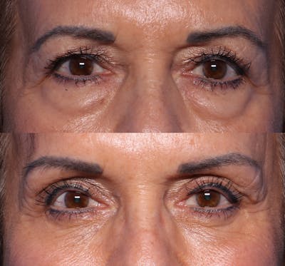 Blepharoplasty Before & After Gallery - Patient 172529 - Image 1