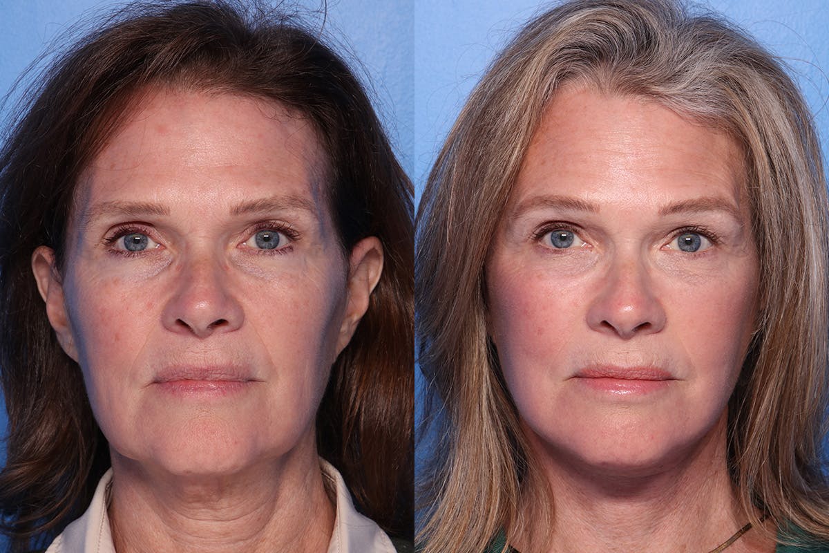 Facelift Before & After Gallery - Patient 342541 - Image 1