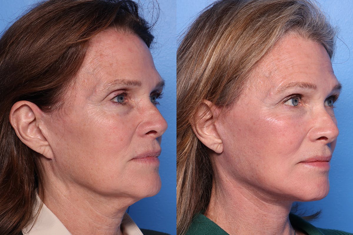 Facelift Before & After Gallery - Patient 342541 - Image 2