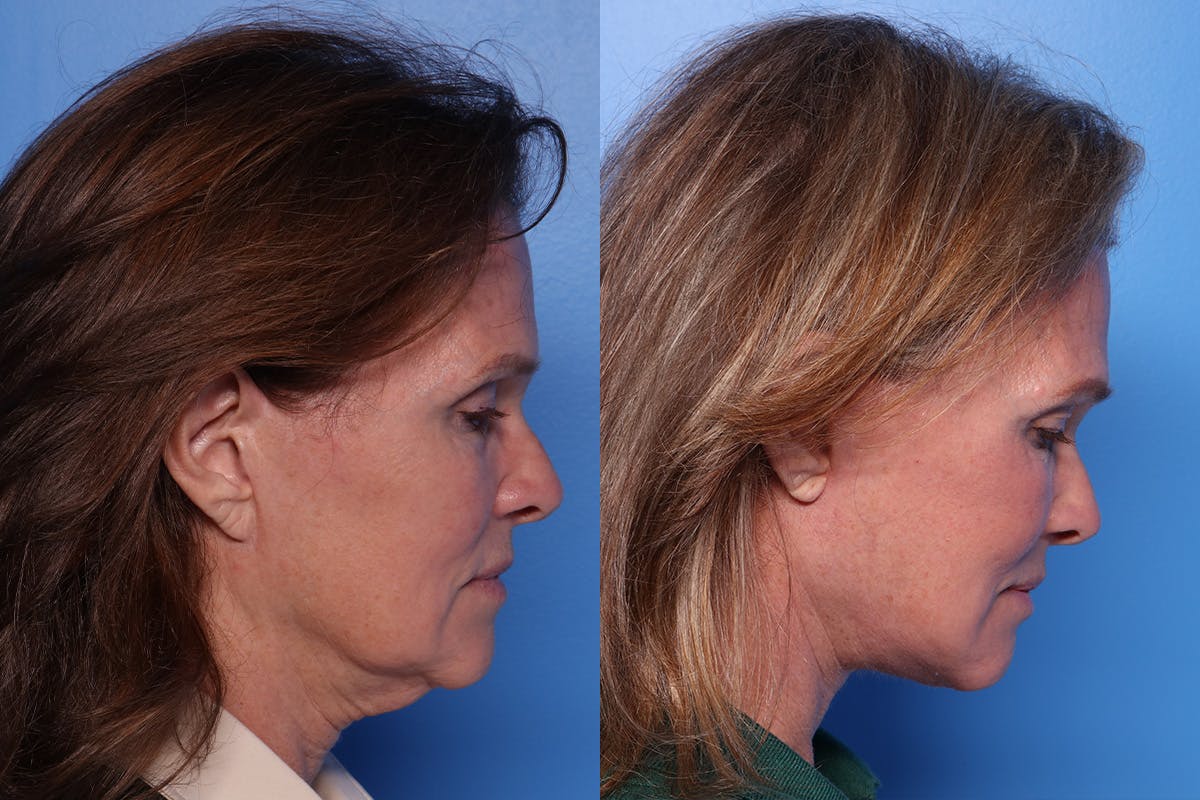 Facelift Before & After Gallery - Patient 342541 - Image 3