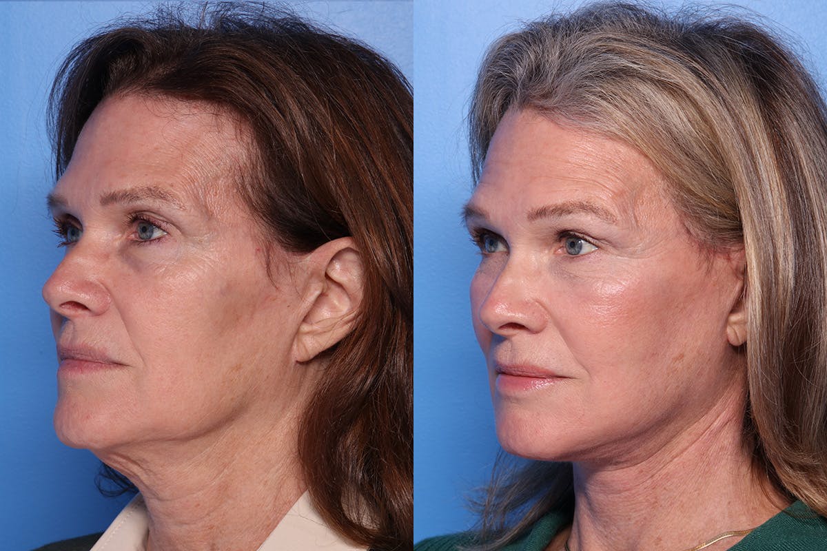 Facelift Before & After Gallery - Patient 342541 - Image 4
