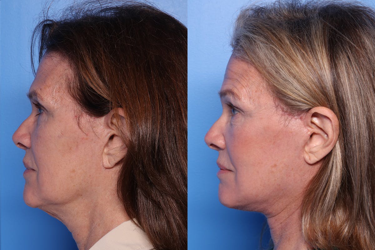 Facelift Before & After Gallery - Patient 342541 - Image 5
