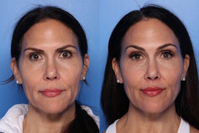 Lip Lift Before & After Gallery - Patient 466009 - Image 1
