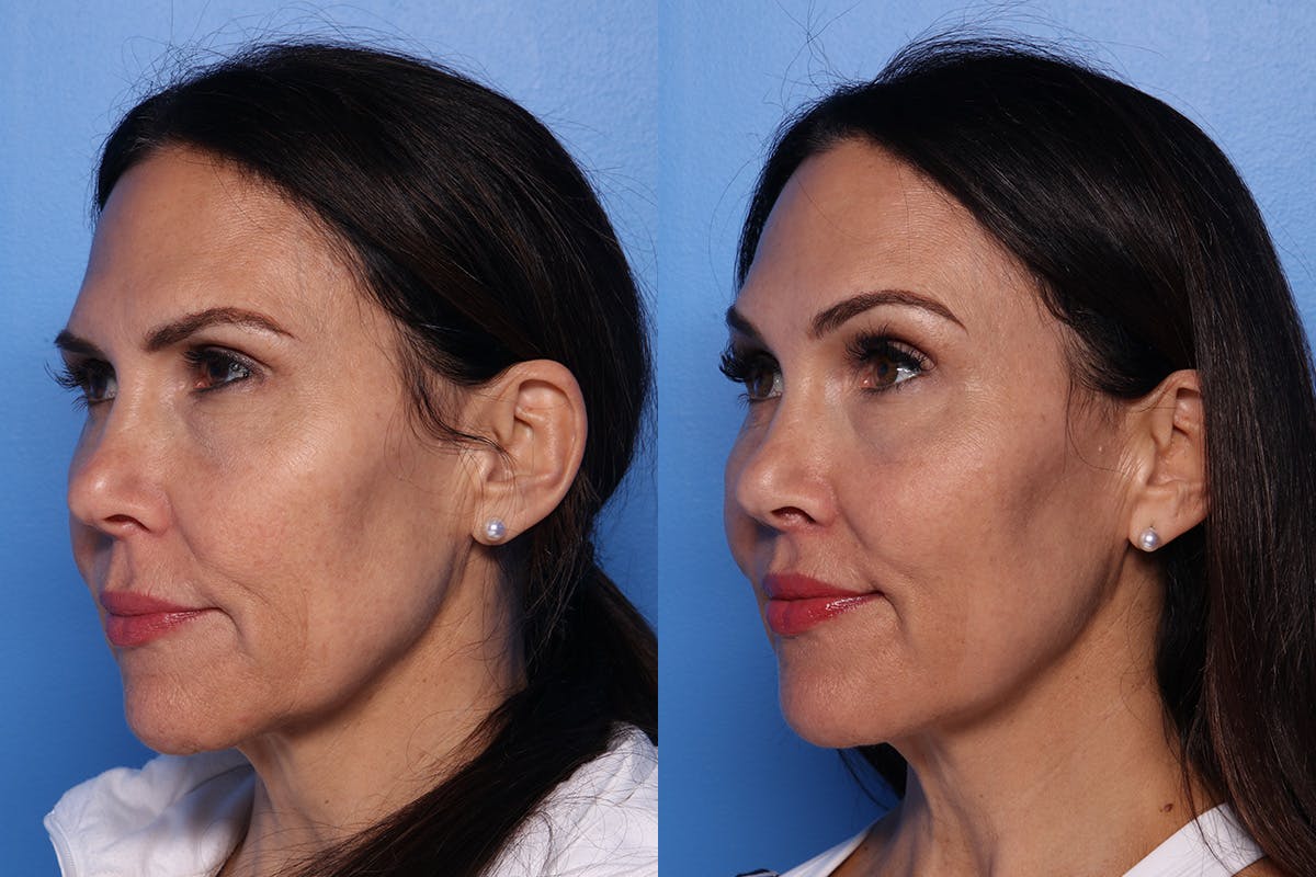 Lip Lift Before & After Gallery - Patient 466009 - Image 4