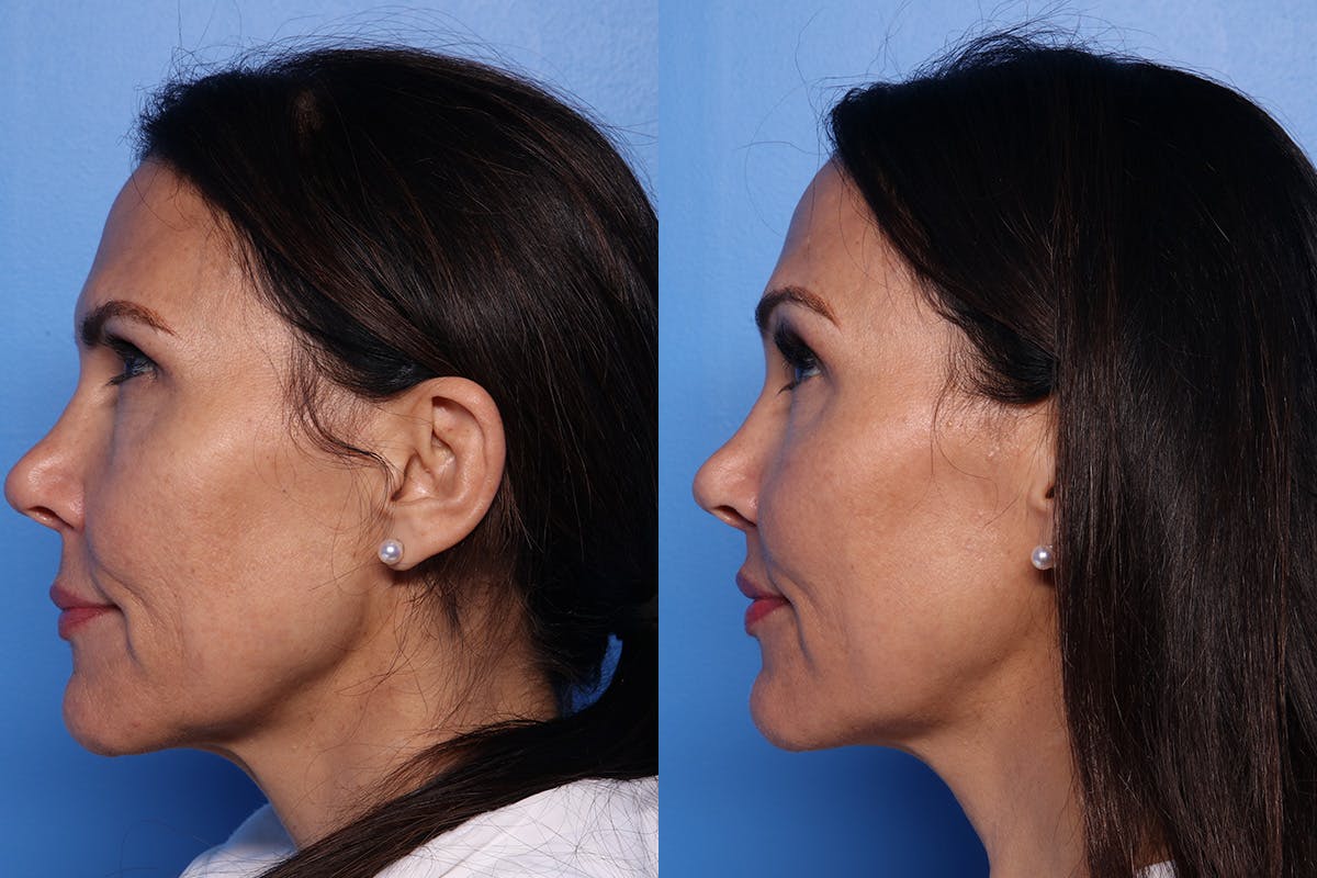 Lip Lift Before & After Gallery - Patient 466009 - Image 5