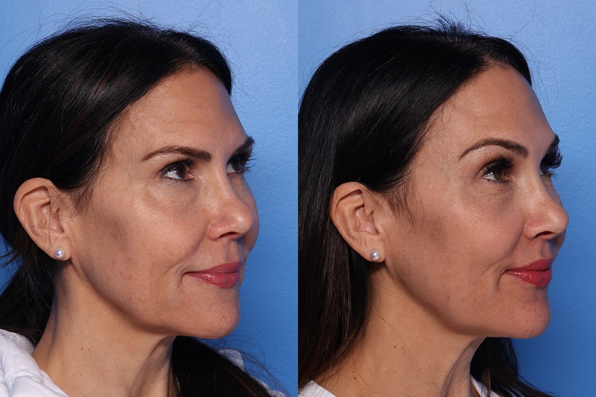 Lip Lift Before & After Gallery - Patient 466009 - Image 2