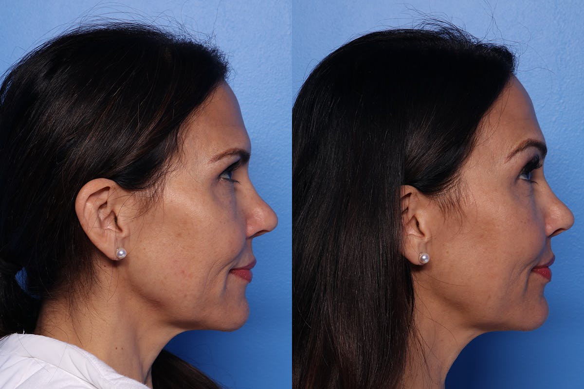 Lip Lift Before & After Gallery - Patient 466009 - Image 3