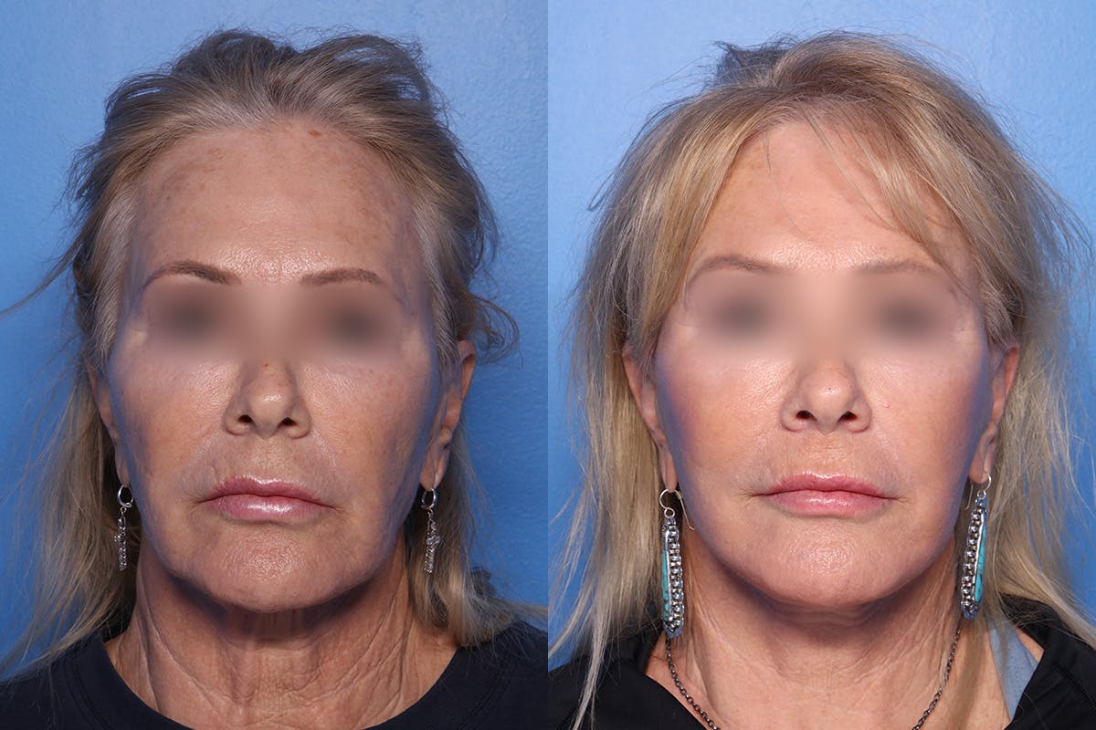 Fat Grafting Before & After Gallery - Patient 112471 - Image 1