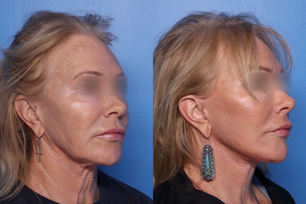 Fat Grafting Before & After Gallery - Patient 112471 - Image 2