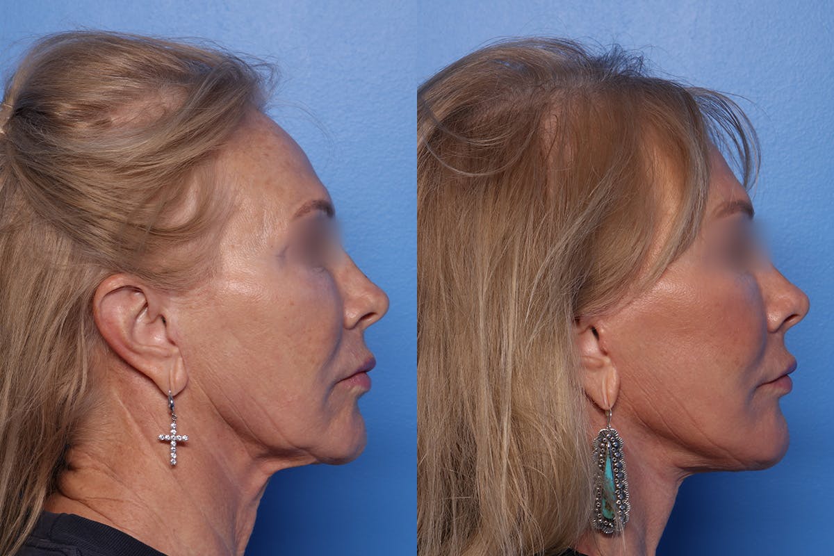 Fat Grafting Before & After Gallery - Patient 112471 - Image 3