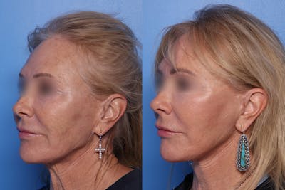 Neck Lift Before & After Gallery - Patient 829754 - Image 1