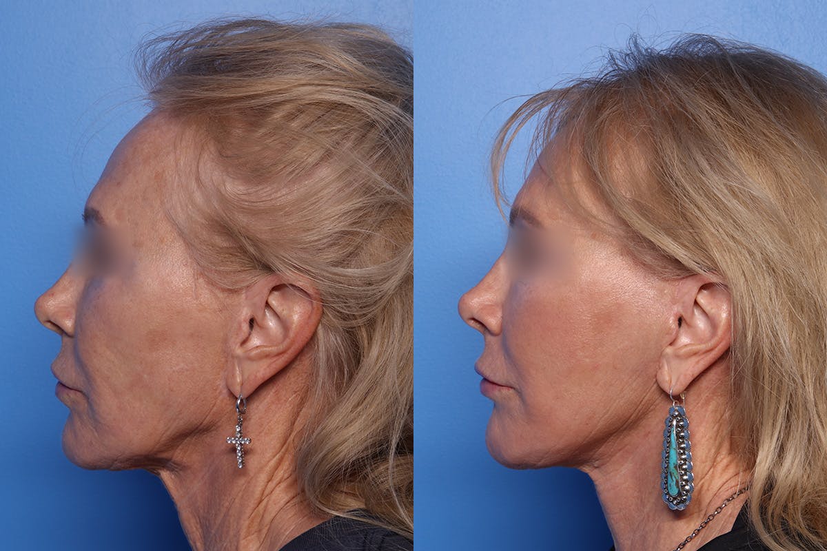 Fat Grafting Before & After Gallery - Patient 112471 - Image 5