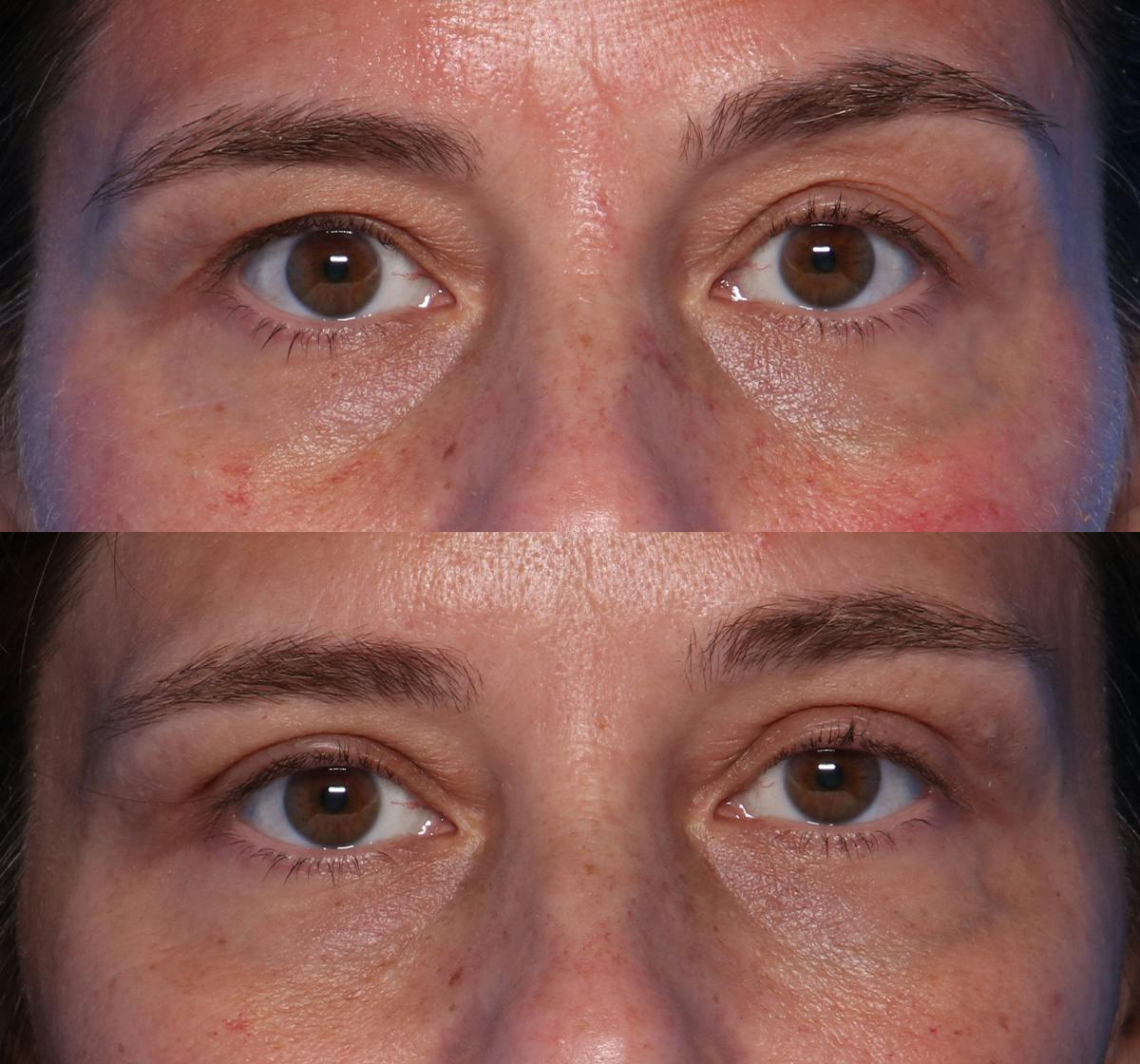 Blepharoplasty Before & After Gallery - Patient 148859 - Image 1