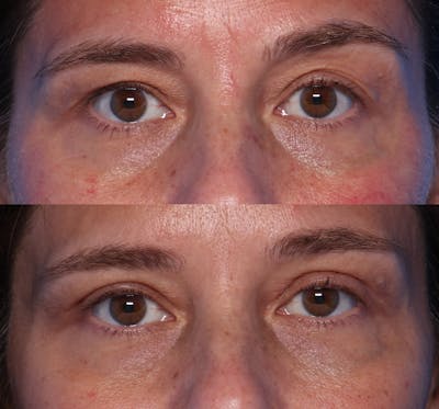 Blepharoplasty Before & After Gallery - Patient 148859 - Image 1