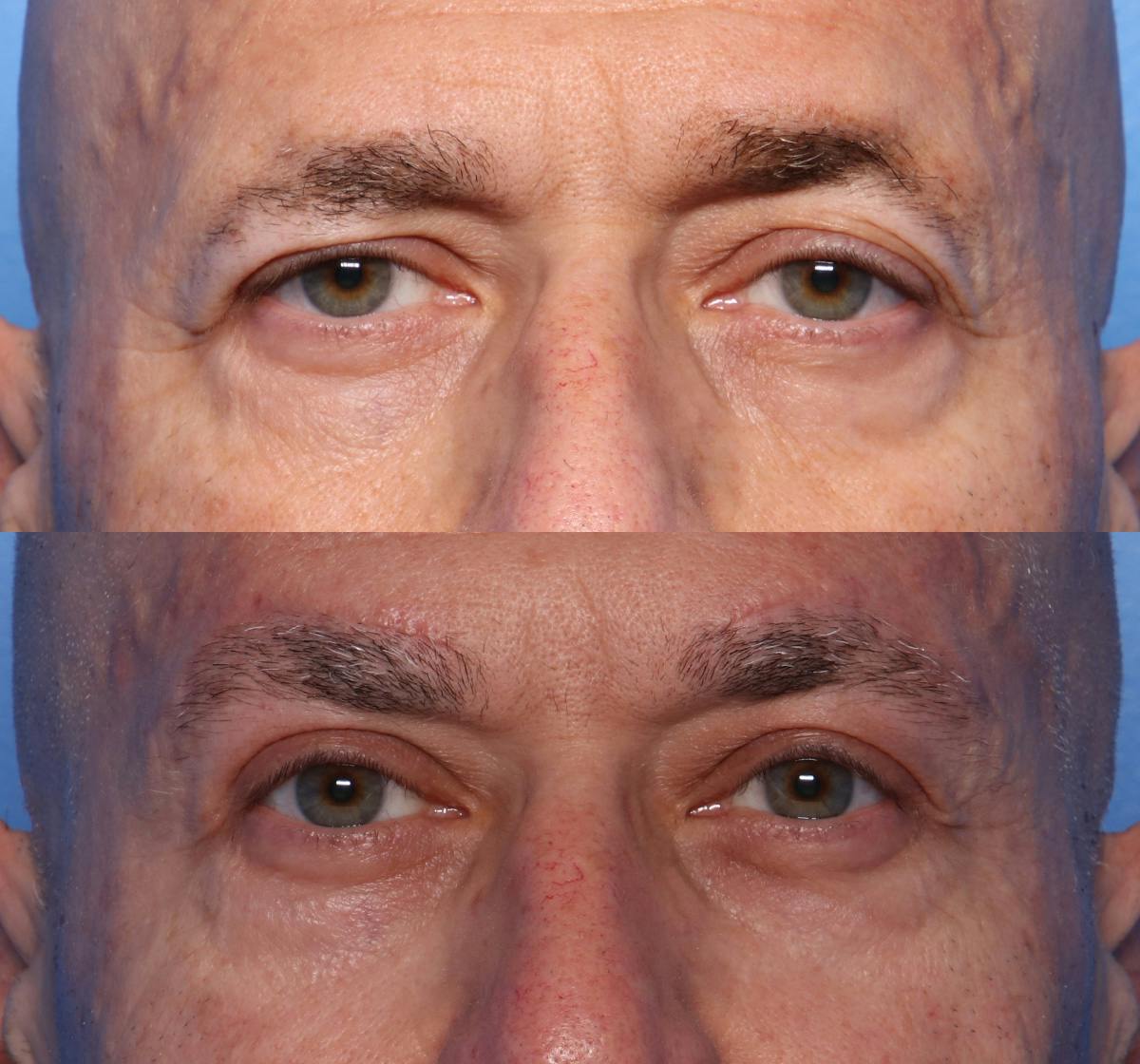 Ptosis Repair Before & After Gallery - Patient 181976 - Image 1