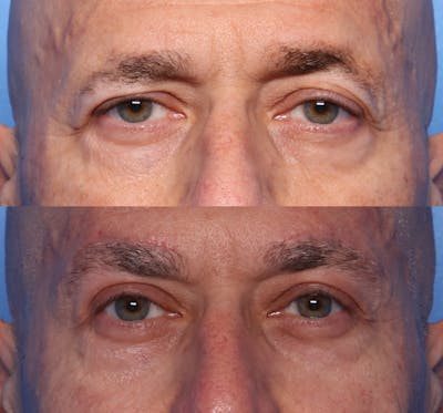 Blepharoplasty Before & After Gallery - Patient 344469 - Image 1