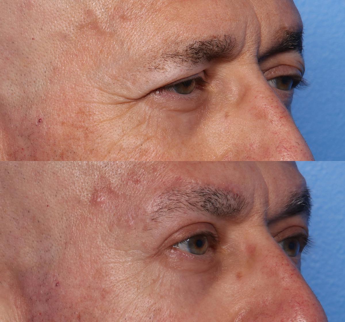 Ptosis Repair Before & After Gallery - Patient 181976 - Image 2