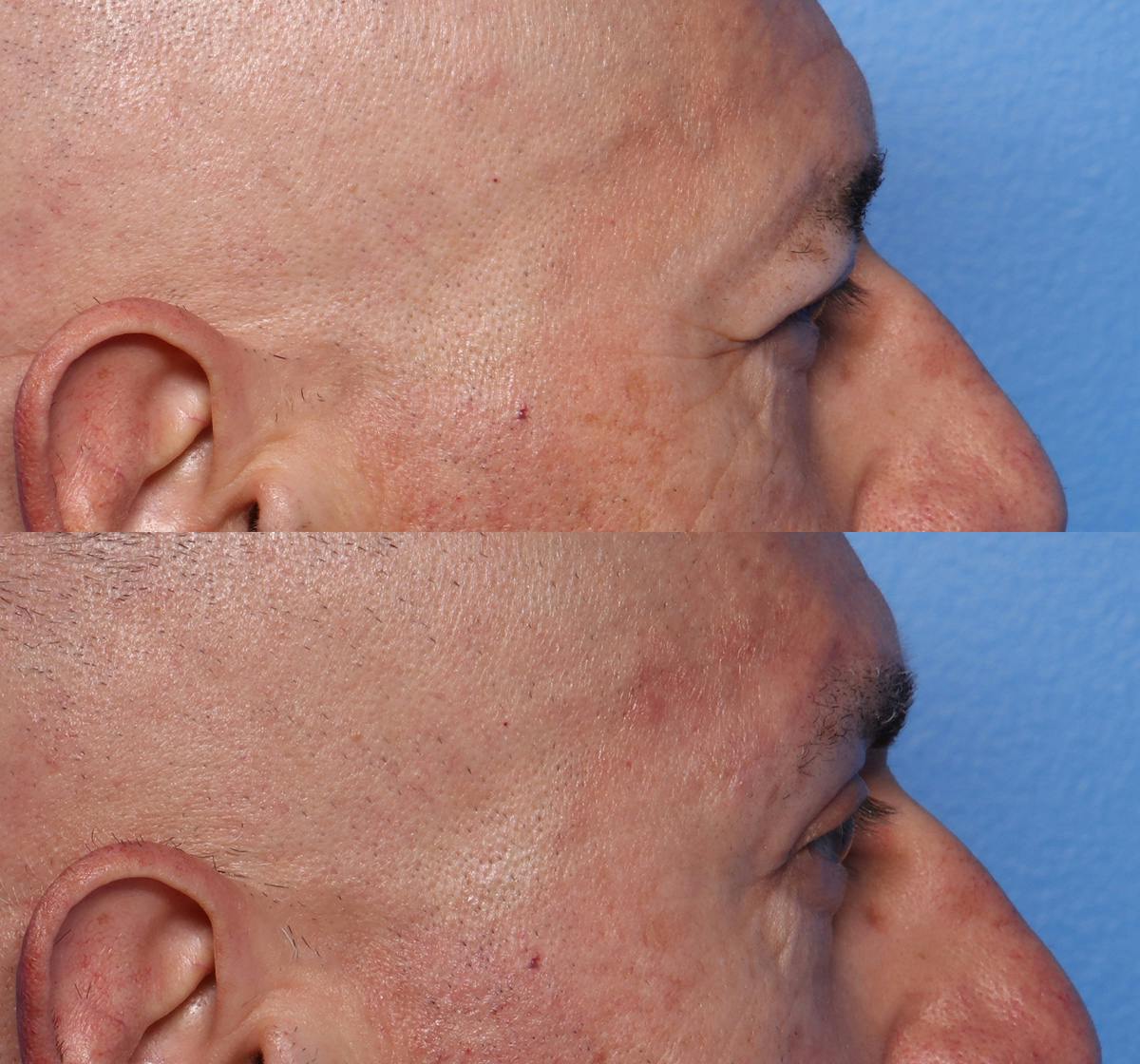 Ptosis Repair Before & After Gallery - Patient 181976 - Image 3