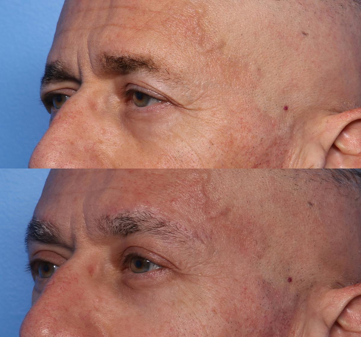 Ptosis Repair Before & After Gallery - Patient 181976 - Image 4