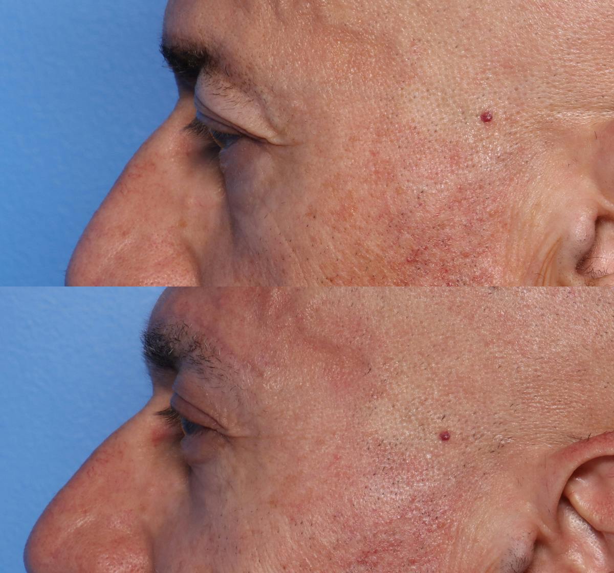 Ptosis Repair Before & After Gallery - Patient 181976 - Image 5