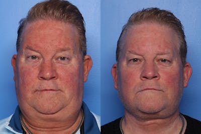 Neck Lift Before & After Gallery - Patient 470361 - Image 1