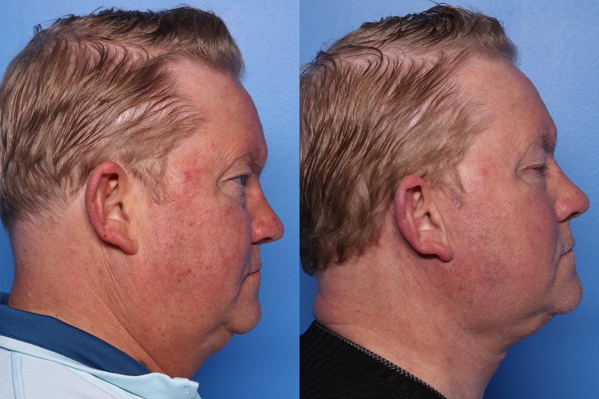 Neck Lift Before & After Gallery - Patient 470361 - Image 3