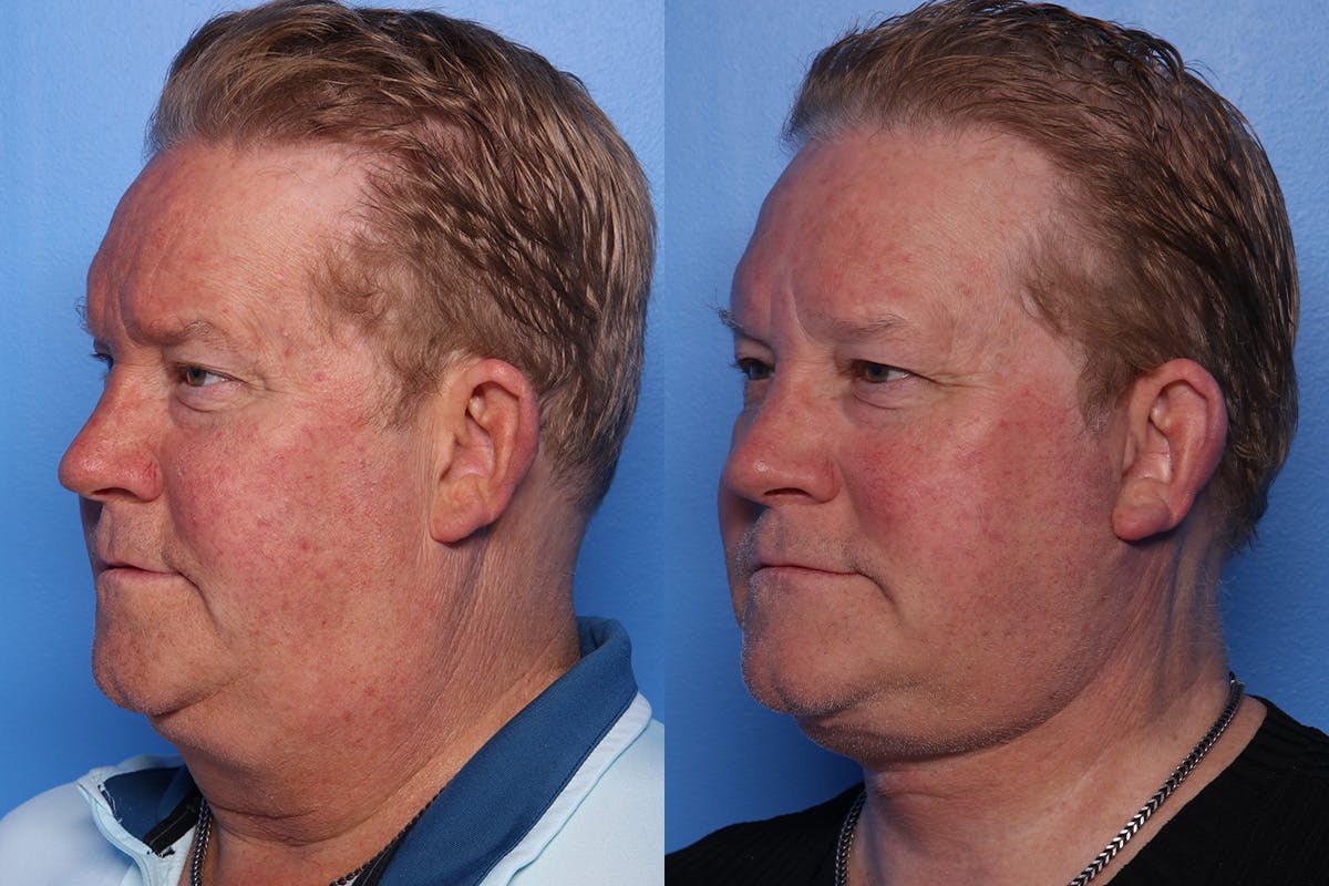 Neck Lift Before & After Gallery - Patient 470361 - Image 4