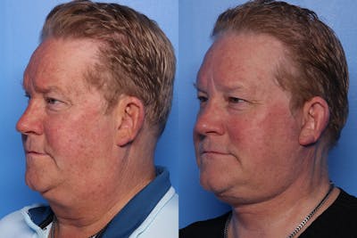 Neck Lift Before & After Gallery - Patient 470361 - Image 1