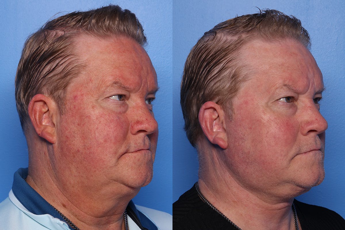 Neck Lift Before & After Gallery - Patient 470361 - Image 2