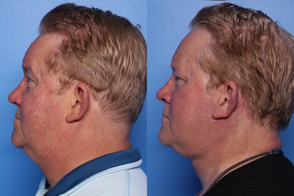 Neck Lift Before & After Gallery - Patient 470361 - Image 5
