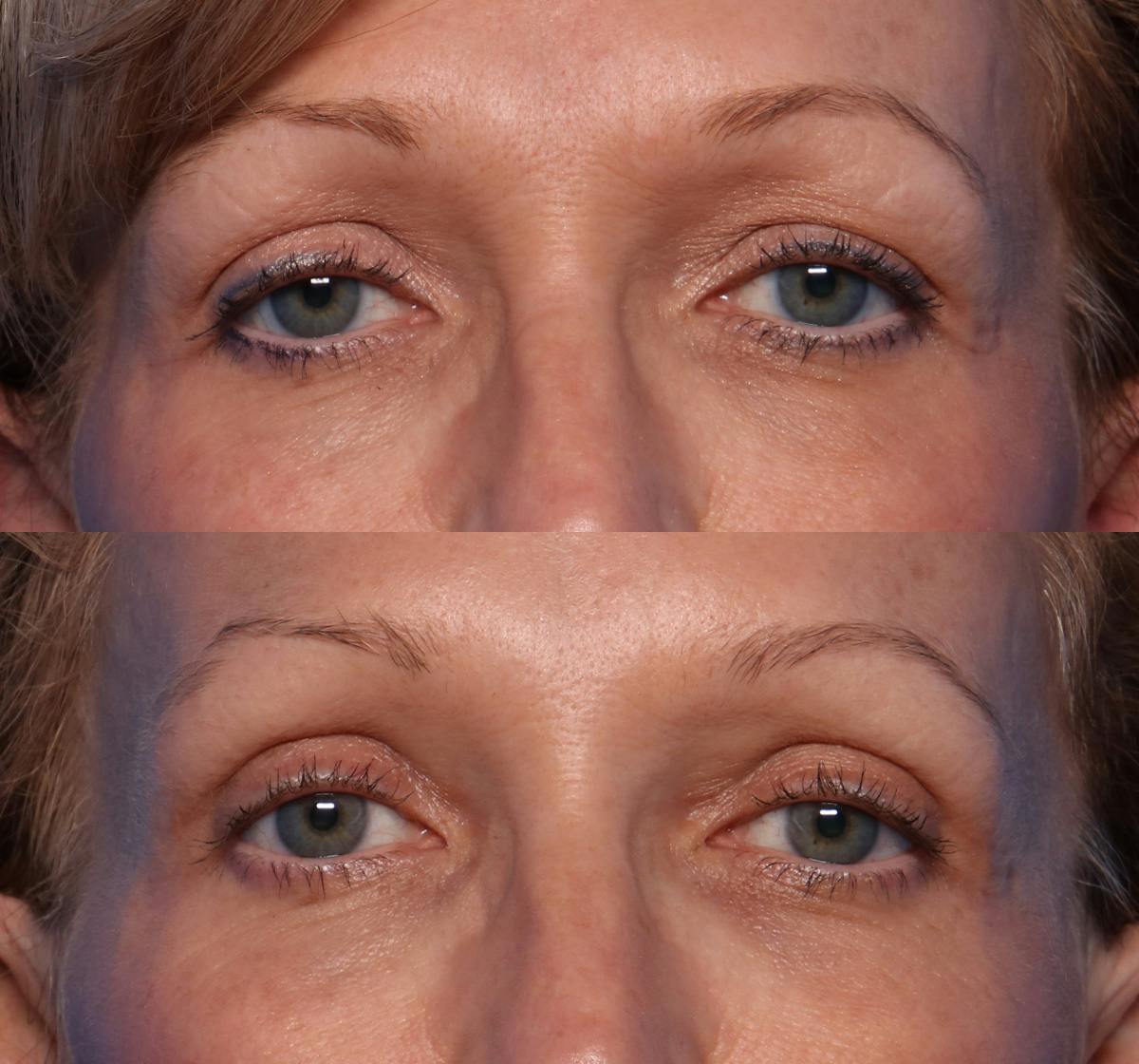 Blepharoplasty Before & After Gallery - Patient 379387 - Image 1