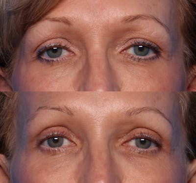 Blepharoplasty Before & After Gallery - Patient 379387 - Image 1