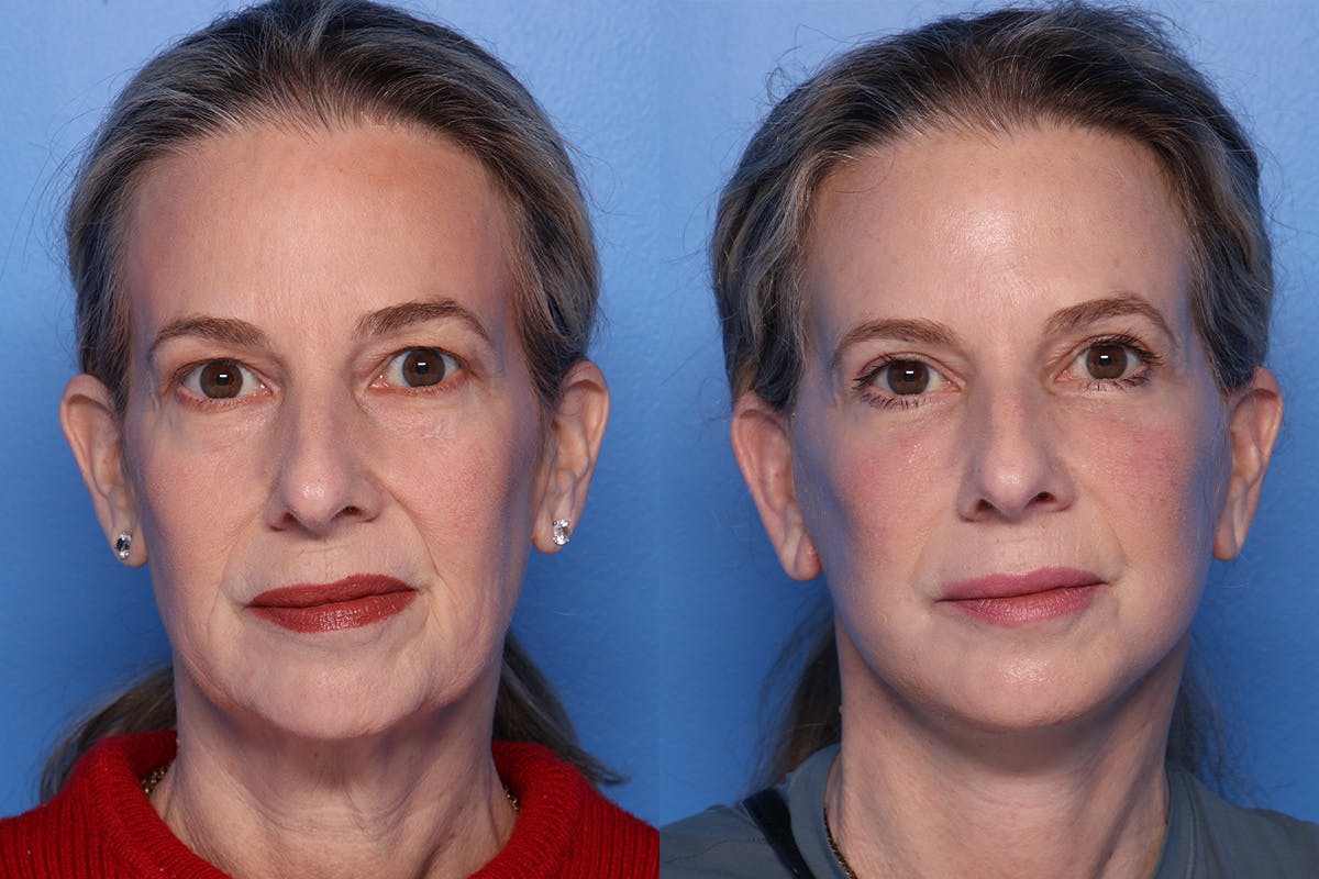 Brow Lift Before & After Gallery - Patient 108886 - Image 1