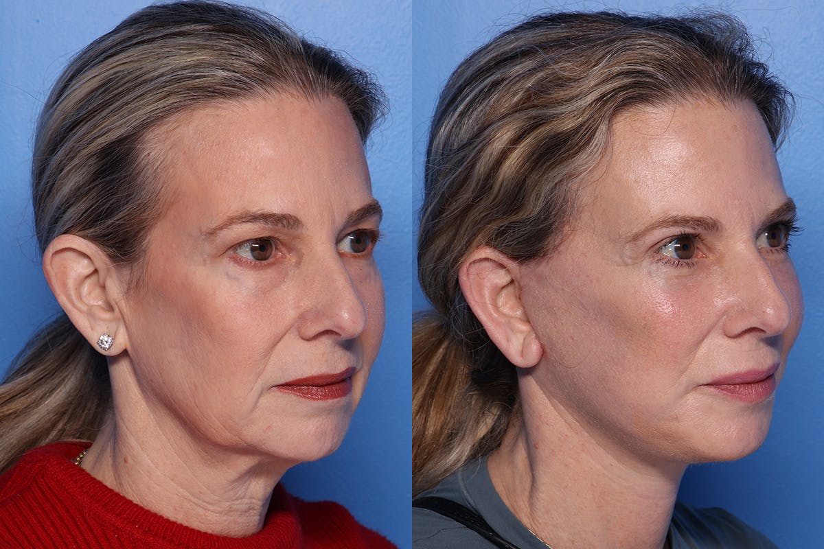 Brow Lift Before & After Gallery - Patient 108886 - Image 2