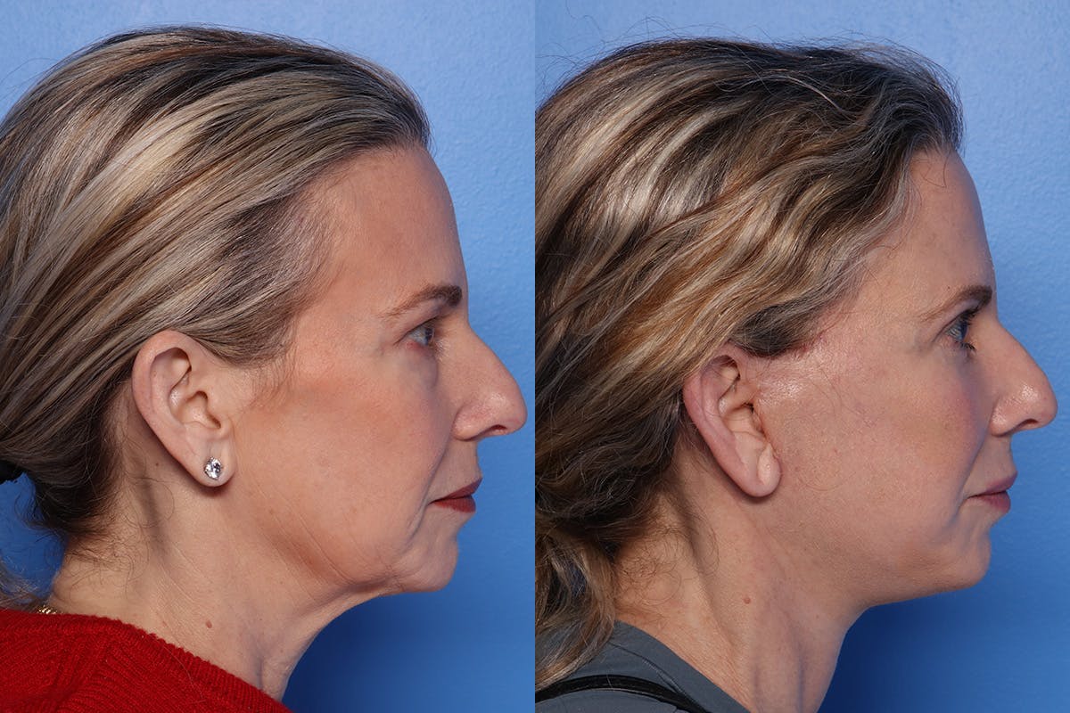 Brow Lift Before & After Gallery - Patient 108886 - Image 3