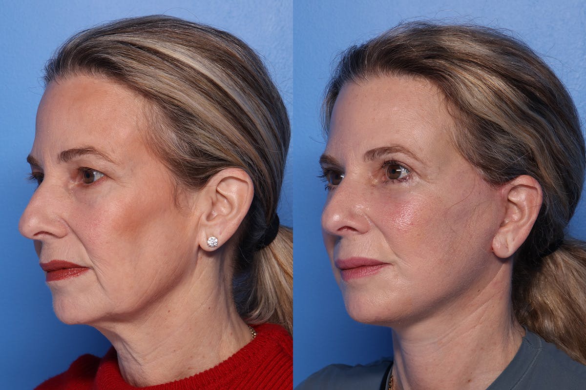 Brow Lift Before & After Gallery - Patient 108886 - Image 4