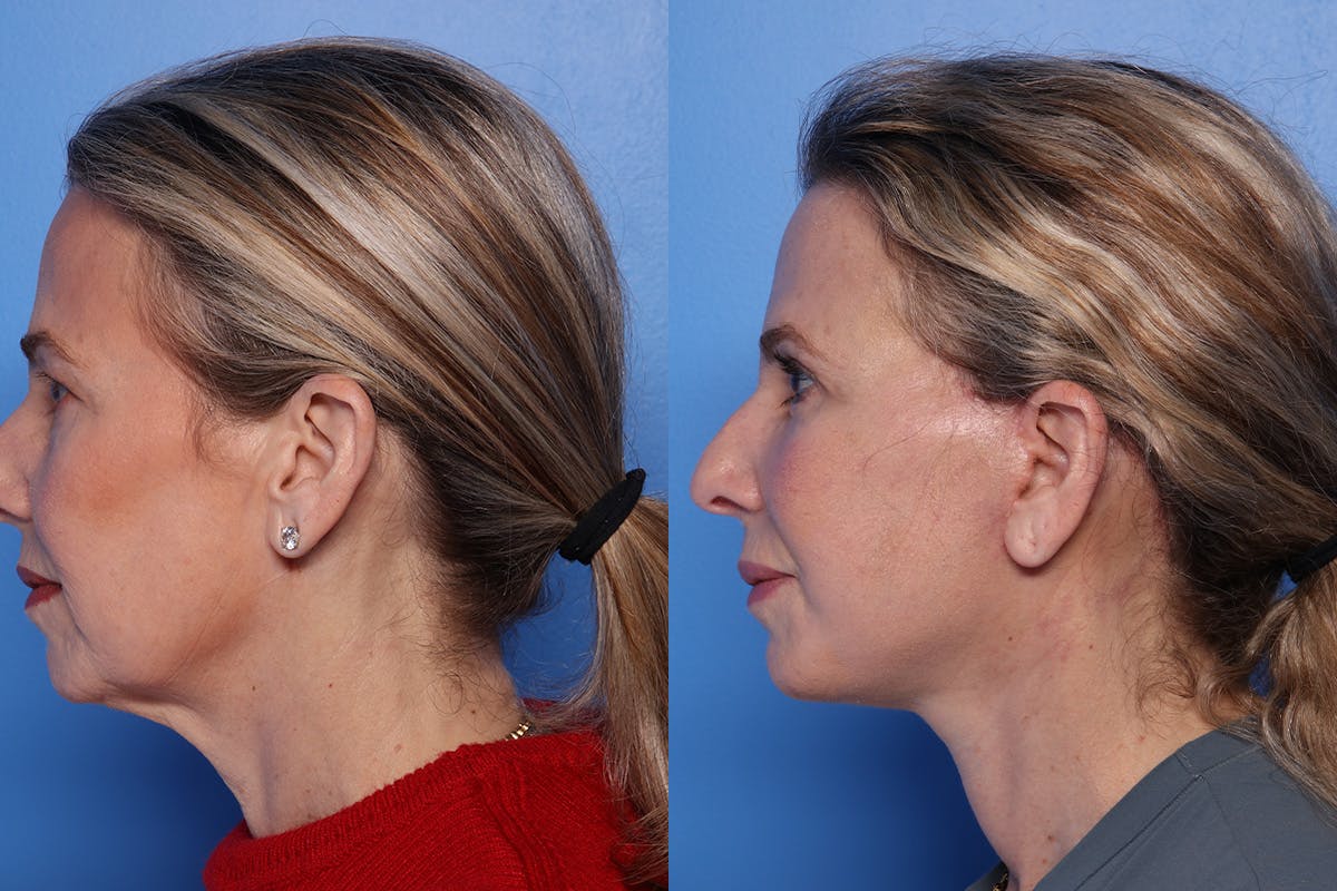 Brow Lift Before & After Gallery - Patient 108886 - Image 5