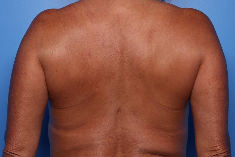 Bra Line Lift Before & After Gallery - Patient 257509 - Image 1