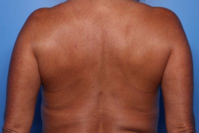 Bra Line Lift Before & After Gallery - Patient 257509 - Image 1