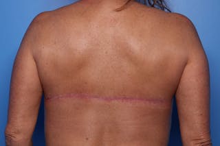 Bra Line Lift Before & After Gallery - Patient 257509 - Image 2