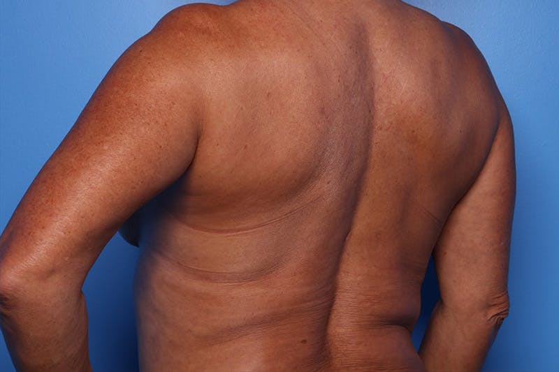 Bra Line Lift Before & After Gallery - Patient 257509 - Image 3