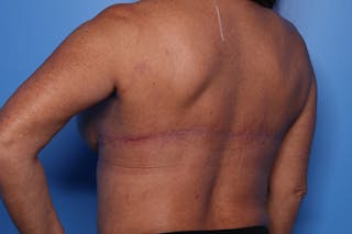 Bra Line Lift Before & After Gallery - Patient 257509 - Image 4