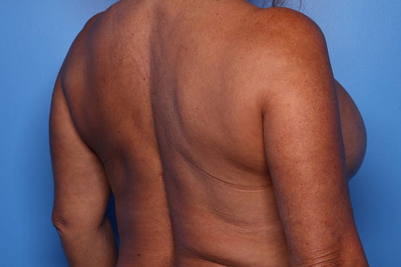 Bra Line Lift Before & After Gallery - Patient 257509 - Image 5