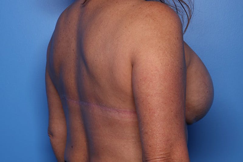 Bra Line Lift Before & After Gallery - Patient 257509 - Image 6