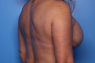 Bra Line Lift Before & After Gallery - Patient 257509 - Image 6