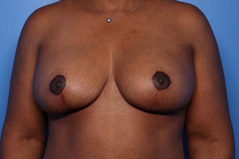 Breast Augmentation + Lift Before & After Gallery - Patient 396288 - Image 2