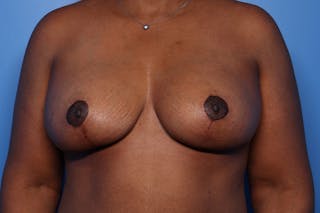 Body Lift Before & After Gallery - Patient 105647 - Image 2