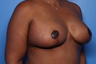 Body Lift Before & After Gallery - Patient 105647 - Image 4